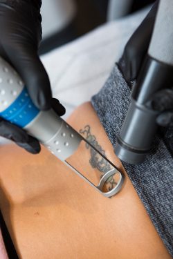 Tattoo Removals – Vivid Skin & Laser Center