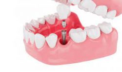 How Much Does A Dental Implant Cost For One Tooth?