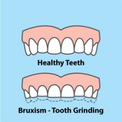 Does Mouth Guard Help Bruxism?