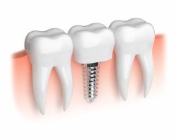 Dental Implant Specialist in Houston, TX