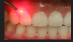 Laser Dentistry – Advanced Laser Dentistry Treatments For Cavities