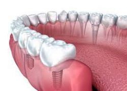 5 Reasons Why Dental Implants Are So Popular -Sapphiresmiles Dentistry