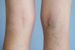Sclerotherapy – New York Vein Treatments