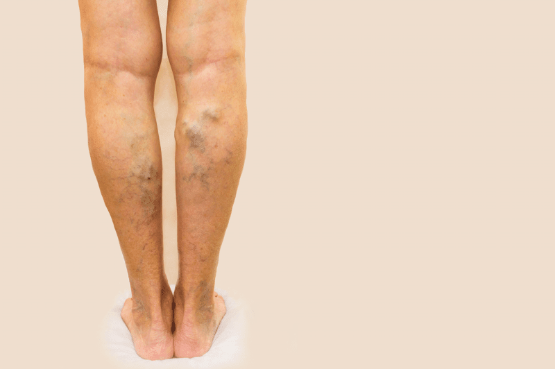 What is the Treatment for Varicose Veins? | Vein Treatment NJ