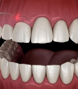 Advanced Gum Infection Treatment