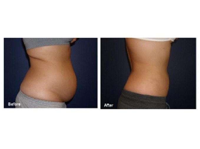 Get Slim Though Liposuction in Chandigarh| Sculpt India