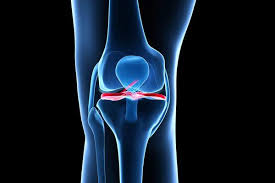 ACL Ligament Surgery In Rajasthan