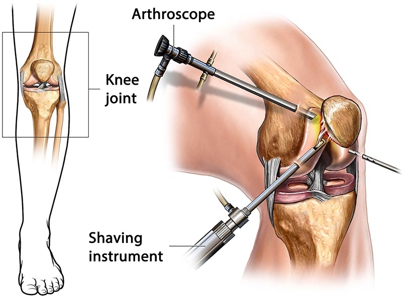 Arthroscopy Surgery In Rajasthan