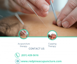 Best Acupuncture therapy in San Jose