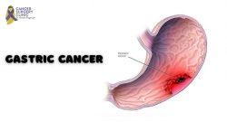 Best Cancer Doctor For Gastric Cancer Treatment