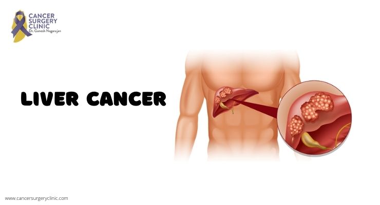 Best Liver Cancer Treatment Doctor in Mumbai