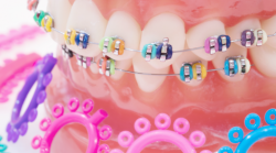 The Ideal Braces Band Colors | Braces Before And After Overbite