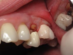 Broken Tooth? Here’s What You Need to Do | General dentistry