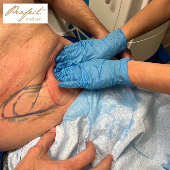 Coolsculpting In New York city
