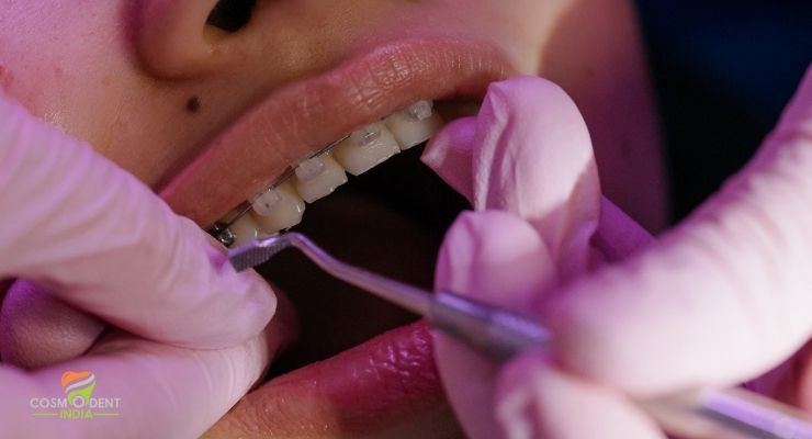CosmodentIndia For Teeth Braces in India