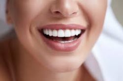 How Much Do Veneers Cost?