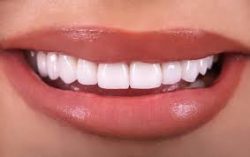 Cost of Veneers for Teeth Gaps