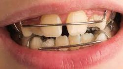 Primary to Permanent Teeth Progression Process | IVANOV Orthodontic Experts
