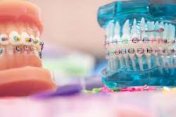Common Questions About Orthodontics | WHAT IS ORTHODONTICS?