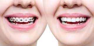 How Much Are Braces? | Invisalign Clear Aligners Versus Braces
