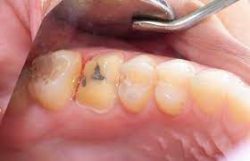 Dental Crown Treatment and Procedure | URBN Dental Houston Tx