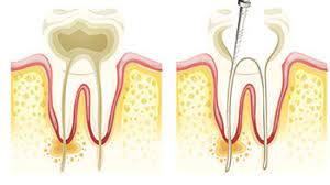 Root Canal Treatment & Therapy Explained by a Dentist Houston, TX