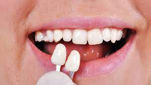 Restorative Dentistry Houston | Restorative Dentistry Near Me – Edge Dental