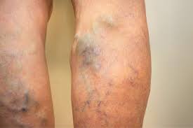 What is a Varicose Vein Specialist Called?