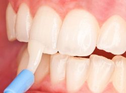 Fluoride Treatments In The Dental Office
