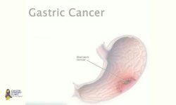 Doctor For Gastric Cancer Treatments in Mumbai