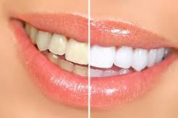 Affordable Dental Implants Near Me | Dental Implant Surgery in Houston