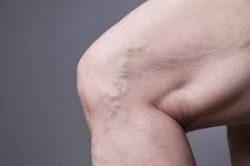 Varicose Veins Before and After | Varicose Vein Treatments in NYC