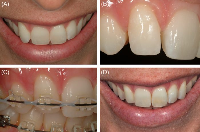 What is Canine Substitution with Missing Lateral Incisors?