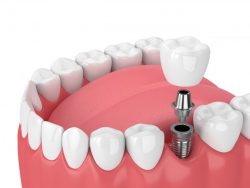 Affordable Partial Dentures in Houston, TX