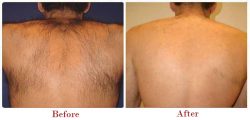 Remove Your Unwanted Hairs Through Laser Hair Removal in Guwahati | Sculpt Clinic