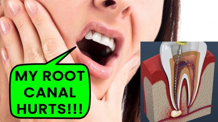 How Long Should a Root Canal Be Sore?