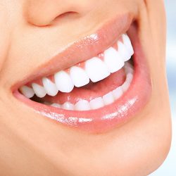 Teeth Whitening Before and After | Gingivectom