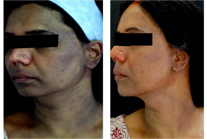 Why we need the Best cosmetic surgeon in Delhi?