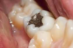 How Much Does Teeth Gap Filling Cost? | Porcelain Veneers