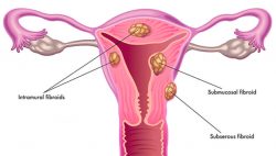 Uterine Fibroid Treatment in Ayurveda