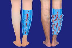 What are the Treatment Options for Varicose Veins? | We Describe the Best Vein Treatments in LI