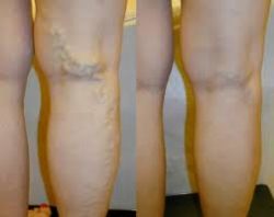 What is the Treatment for Varicose Veins? | Vein treatment New York City