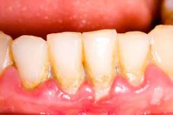 Dental Scaling and Root Planing for Gum Disease – Edge Dental