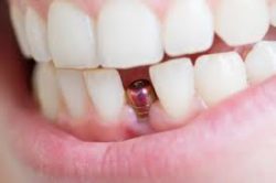 Affordable Dental Bridge Tooth Replacement