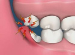 Wisdom Tooth Extraction in North Miami