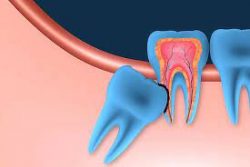 Wisdom Tooth Extraction Near Me
