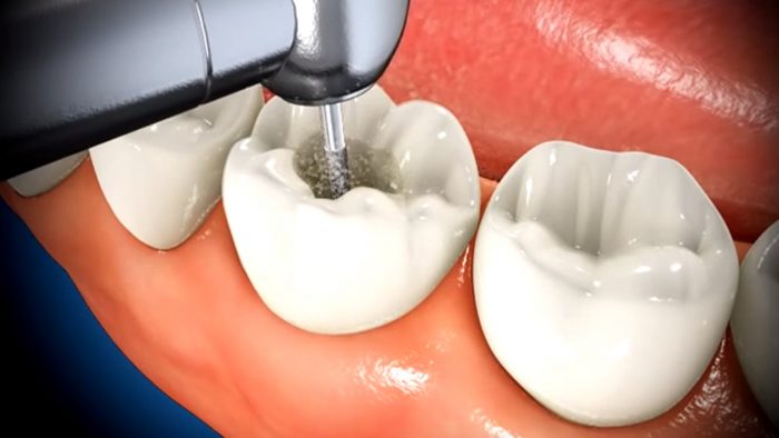 Root Canal Procedure & Treatment Specialist | Root Canal Dentist