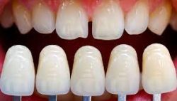 Porcelain Dental Veneers Cost