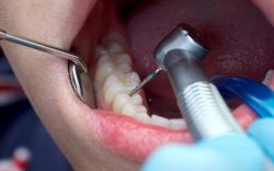 Root Canal Dentist in Houston, TX