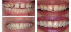 Cosmetic Dentistry Near Me | Cosmetic Dentistry Treatment Procedures